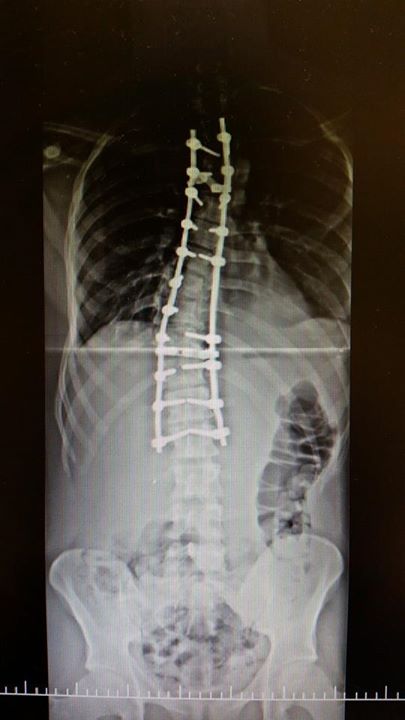 Escoliose Pós Tratamento