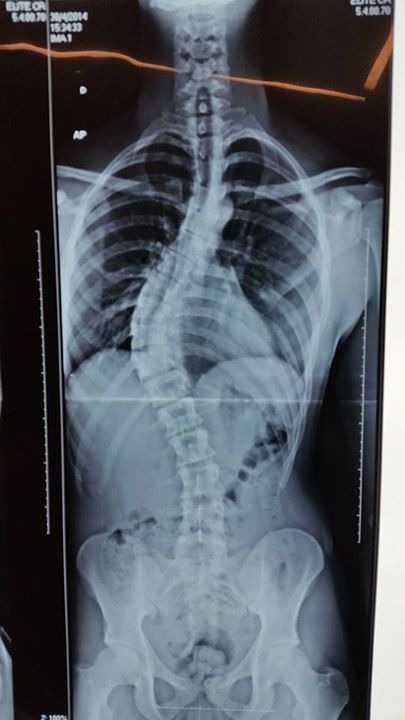 Escoliose Pré Tratamento