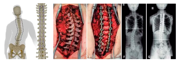 Opções cirúrgicas para escoliose idiopática