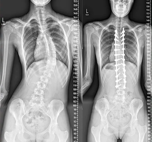 Correção de escoliose “C” idiopática toracolombar