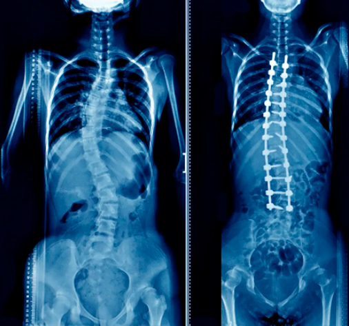 Correção de escoliose “S” idiopática dupla-curva 