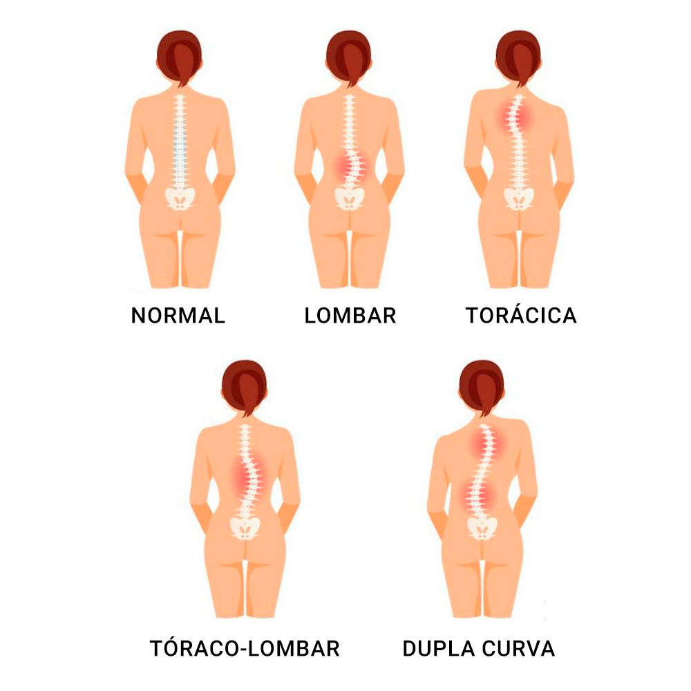 Tipos de Escoliose